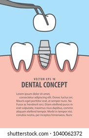 Layout Implant teeth illustration vector on blue background. Dental concept.