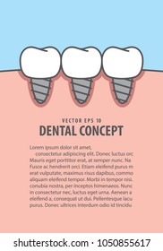 Layout Implant teeth illustration vector on blue background. Dental concept.