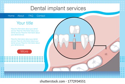 Layout for orthodontic services website with teeth and implant for orthodontic services and implantation. Molars and incisors top view. Vector stock illustration with layout or web template.