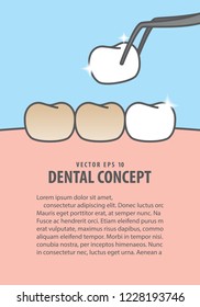 Layout Putting new veneer on discolored tooth illustration vector on blue background. Dental concept.