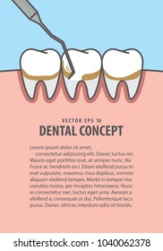 Layout Scaling teeth illustration vector on blue background. Dental concept.