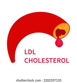 LDL Cholesterol Level Causing Blood Clot In A Vessel. Ldl Lipoprotein Medical Diagram. High Fat Test Indicator. Hyperlipidemia And Coronary Disease Risk. Healthcare Concept. Vector Illustration.