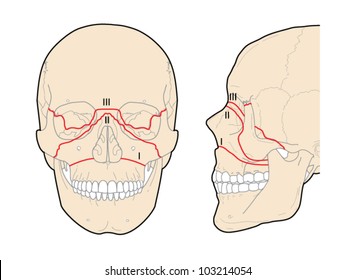 Le Fort skull fractures