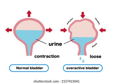 Leakage of urine Illustration of bladder mechanism