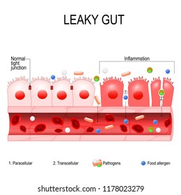 leaky gut. cells on gut lining held tightly together. in intestine with celiac disease and gluten sensitivity these tight junctions come apart. autoimmune disorder. Vector diagram