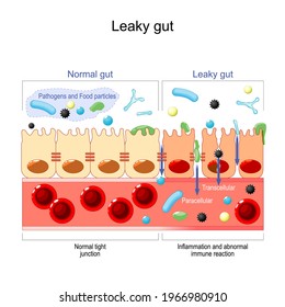 leaky gut. cells on gut lining held tightly together. in intestine with celiac disease and gluten sensitivity these tight junctions come apart. autoimmune disorder. Vector illustration