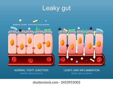 Leckender Darm. Nahaufnahme von Zellen eines Darmepithels. Unterschied zwischen gesunden Zellen und entzündeten Darmzellen.  Darmpermeabilität. Vektorgrafik-Poster. isometrische flache Darstellung