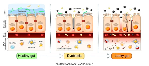 Vazamento intestinal. Progressão do intestino saudável para disbiose e permeabilidade intestinal. Close de células de um epitélio intestinal. Cartaz Vetor Detalhado