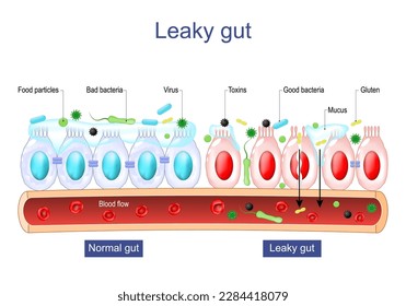 Leaky gut Syndrome. difference between Healthy cells, and inflamed intestinal cells. Intestinal permeability. Gut barrier dysfunction. Intestinal inflammation. Vector poster