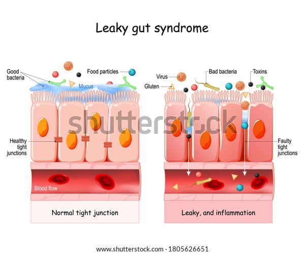 Leaky gut Syndrome. difference between Healthy cells, and inflamed intestinal cells. Comparison normal tissue of the gastrointestinal tract, and leaky gut.