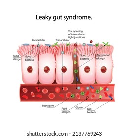 Leaky gut syndrome. Healthy cells and inflamed intestinal cells.Paracellular and  Transcellular transport route.