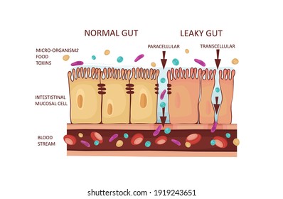 Leaky Gut Syndrome or Intestinal Permeability Diagram. Autoimmune disorder. Vector illustration