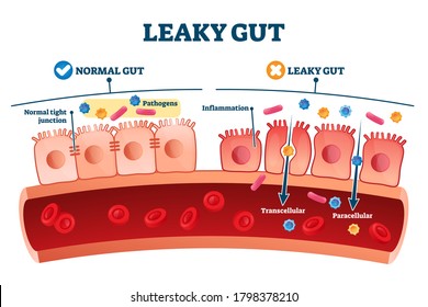 Leaky gut syndrome as medical chronic inflammation condition explanation. Labeled autoimmune health problem with transcellular and paracellular pathogens penetration in bloodstream vector illustration