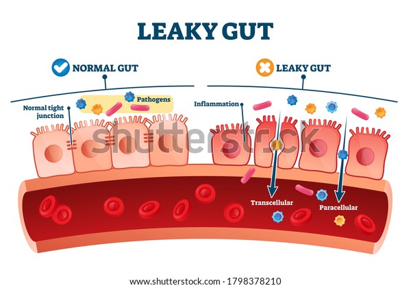 Leaky gut syndrome as medical chronic\
inflammation condition explanation. Labeled autoimmune health\
problem with transcellular and paracellular pathogens penetration\
in bloodstream vector\
illustration