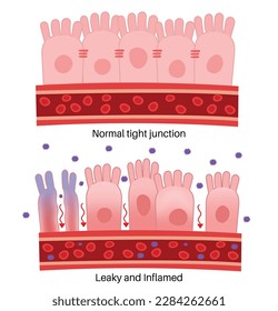 Leaky Gut Syndrome : Normal tight junction, Leaky and Inflammation.