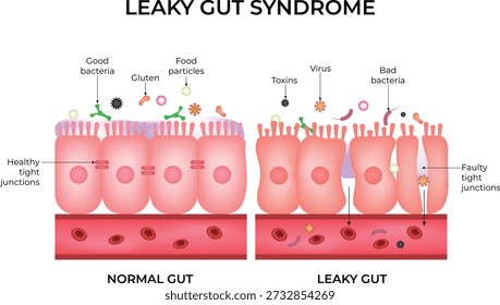 Síndrome del intestino permeable Barrera intestinal normal vs defectuosa