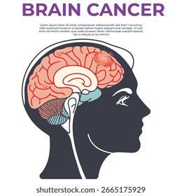 Learn about brain cancer symptoms causes treatments and prevention tips Get expert insights on managing brain tumor health effectively