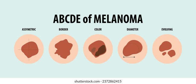 Obtener información sobre diferentes tipos de cáncer de piel a través de ilustraciones vectoriales