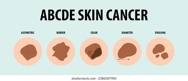 Learn about different types of skin cancer through vector illustrations