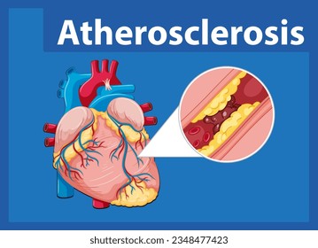 Learn about heart health and the development of atherosclerosis in this educational infographic