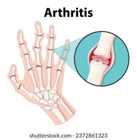 Informieren Sie sich über Anatomie und Arthritis des Menschen in einer wissenschaftlichen Ausbildung