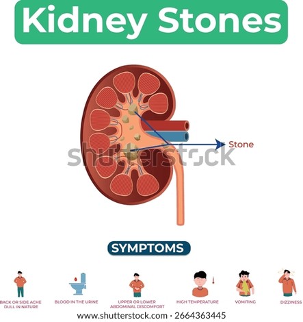 Learn about kidney stones causes symptoms prevention and treatment options to manage this painful condition effectively and improve kidney health