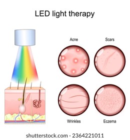 LED light therapy for skin-related issues, like Acne treatment, Scars, and Wrinkles reduction, and Eczema management. Phototherapy for Skin rejuvenation. Vector illustration