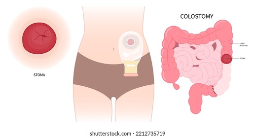 Left abdomen Pouch ileum Colon stoma removal Surgery with Tumor Small Large inflammation of Crohn and Hirschsprung disease blocked hernia Cancer to poo stool Loop invasive tract Rectal system