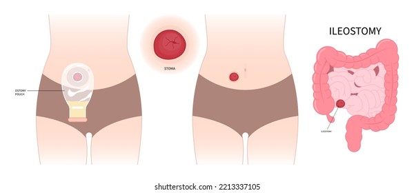 Left abdomen Pouch ileum Colon stoma removal Surgery with Tumor Small Large inflammation of Crohn and Hirschsprung disease blocked hernia Cancer to poo stool Loop invasive tract Rectal system