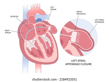 Left Arterial Appendage Closure Device Implant Stock Vector (Royalty ...