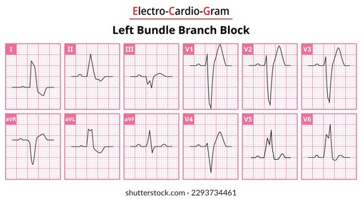 Left Bundle Branch Block - The Differences in ECG Waveform for Each of the 12 Leads - Medical Vector and Illustration