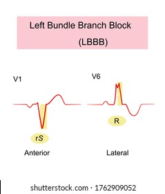 Left Bundle Branch Block Lbbb Ecg Stock Vector (Royalty Free) 1762909052