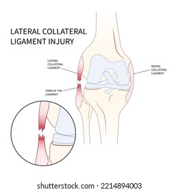 Linke seitliche Nebenverbindungs-Verletzung des Knie der Anatomie medizinisch