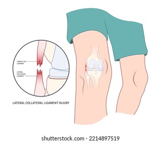 verdrehtes Knie mit schmerzhaftem Symptom, das eine Meniskus-Tränenverletzung verursacht