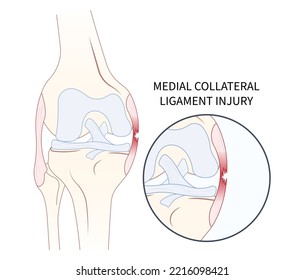 Left lateral Medial collateral ligament Injury with pop femur of athletic meniscal test Grade hurt