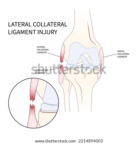 Left lateral Medial collateral ligament Injury with pop femur of athletic meniscal test Grade hurt