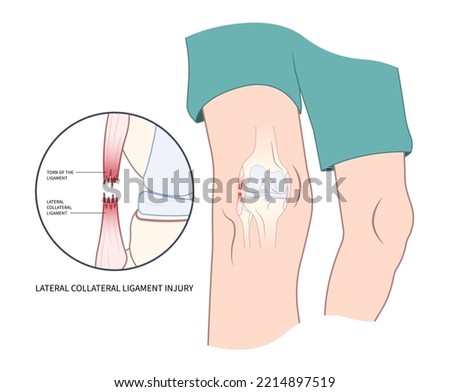 Left lateral Medial collateral ligament Injury with pop femur of athletic meniscal test Grade hurt
