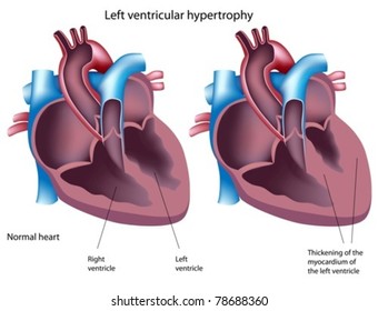 Left ventricular hypertrophy