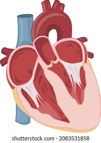 left ventricular hypertrophy due to hypertension illustration