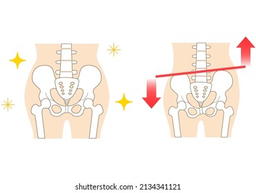 Pelvis inclinado a la izquierda y postura