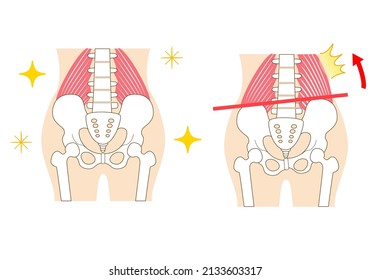 Left-right tilted pelvis and quadratus lumborum
