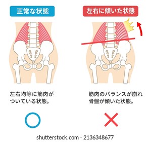 Left-right tilted pelvis and quadratus lumborum 
Translation:
Correctly positioned pelvis and tilted pelvis
