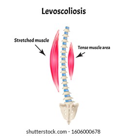 Left-sided scoliosis. Levoscoliosis. Muscles and spine. Spinal curvature in scoliosis. Infographics. Vector illustration on isolated background.