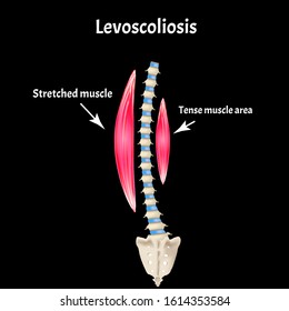 Left-sided scoliosis. Levoscoliosis. Muscles and spine. Spinal curvature in scoliosis. Infographics. Vector illustration.