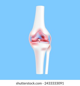 Knorpel und Bänder der Beine beschädigt Osteoarthritis oder schwere Arthritis Kniegelenk. Medizinisches Wissenschaftskonzept. 3D realistischer Vektor EPS10.