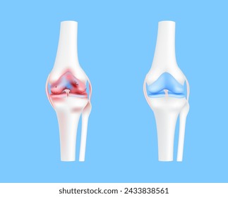 Lesión del cartílago del hueso de la pierna sana y artrosis o artritis grave articulación de la rodilla sobre fondo azul. Concepto de ciencia médica. Vector realista 3D EPS10.