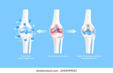 Leg bone and cartilage ligament. Osteoporosis or arthritis joint. Nourish with dietary supplements and Innovation medical technology treatment. Knee replacement surgery or implant. 3D vector.