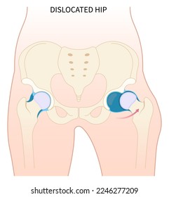 Linker Oberschenkelknochenbruch die Verletzung in der Medizin