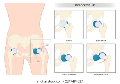 Tipos de clasificación de la artrosis o de la artritis degenerativa en el hueso de la cadera que causan hinchazón y conducen al cáncer 