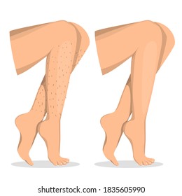 Leg depilation before and after vector isolated. Female body, hair removal. Skin care, epilation procedure. Illustration of a beautiful body.